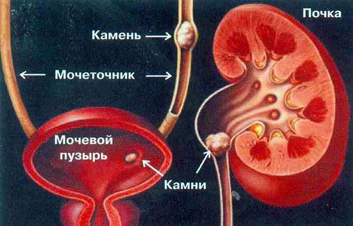Kamienie nerkowe: leczenie środkami folk