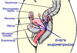 Endometrioza: leczenie środkami folk
