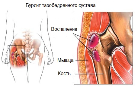 Leczenie chorób stawu biodrowego środków ludowej