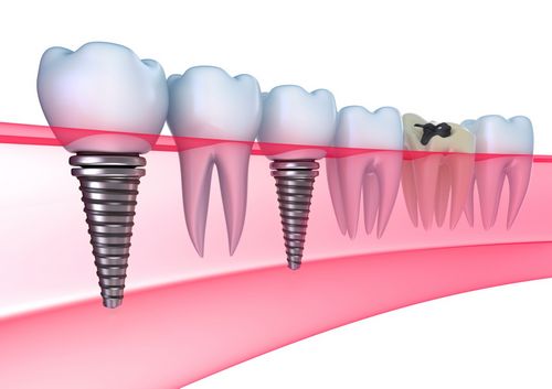Czy implantacja dentystyczna jest luksusem czy koniecznością? 