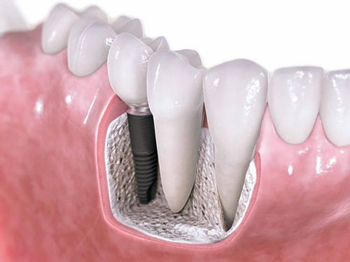 Czy implantacja dentystyczna jest luksusem czy koniecznością? 