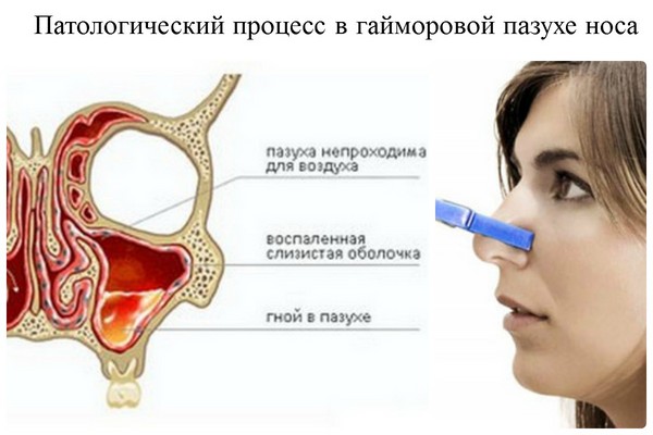 Brown snot: dlaczego ważne jest, aby rozpocząć leczenie na czas