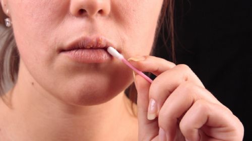 Skuteczne sposoby leczenia przeziębienia na wargach