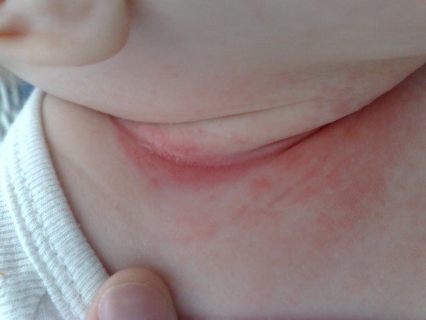 Czy wystąpiła wysypka na szyi dorosłego lub dziecka? Główne metody leczenia i profilaktyki wysypki szyjkowej